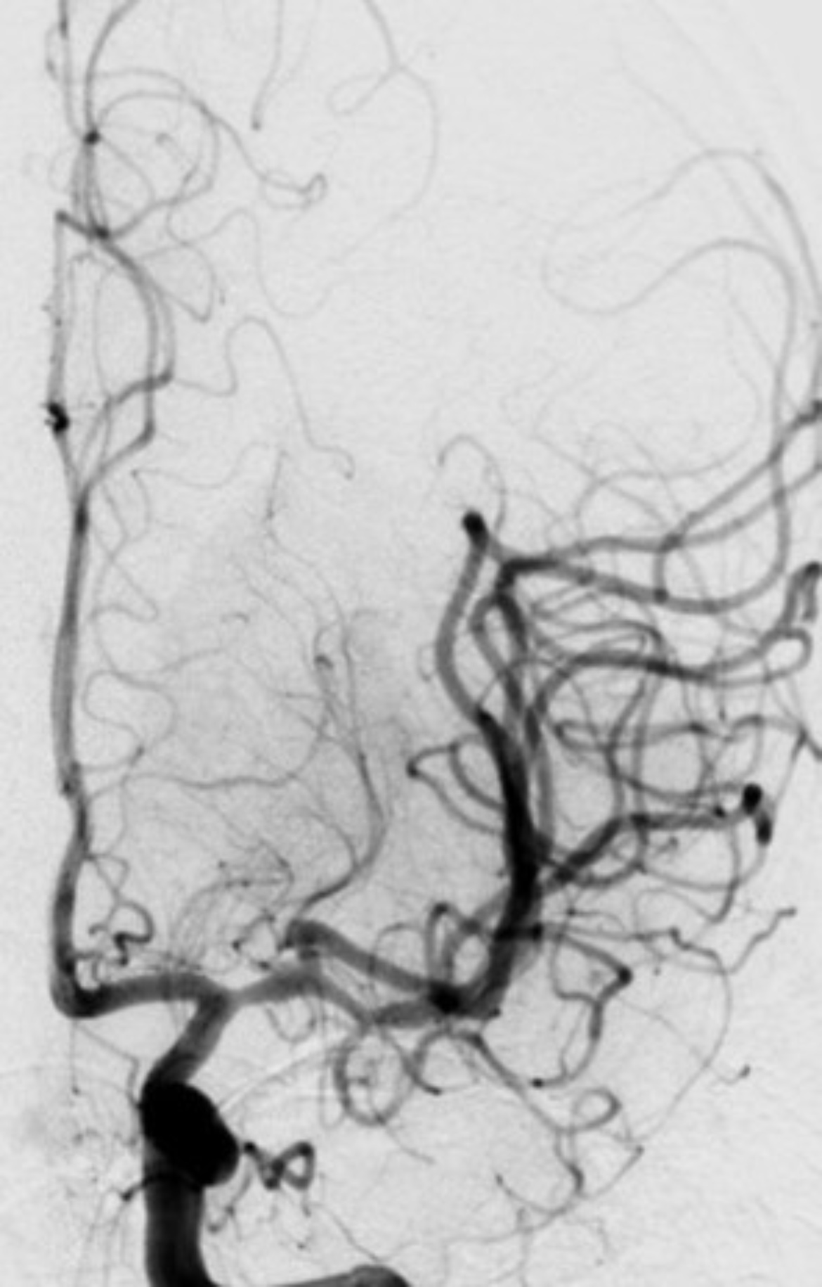 Brain vessel anatomy on contrast enhanced fluoroscopy